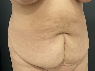 Tummy Tuck Before & After Gallery - Patient 462190 - Image 1