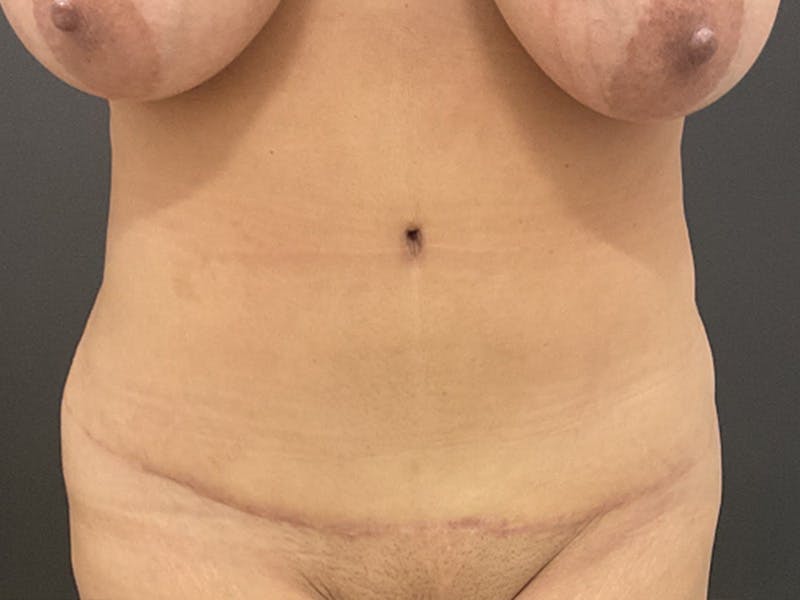 Tummy Tuck Before & After Gallery - Patient 462190 - Image 2