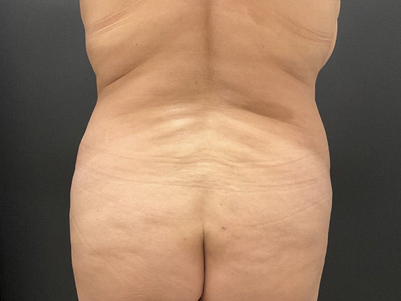 Tummy Tuck Before & After Gallery - Patient 462190 - Image 3