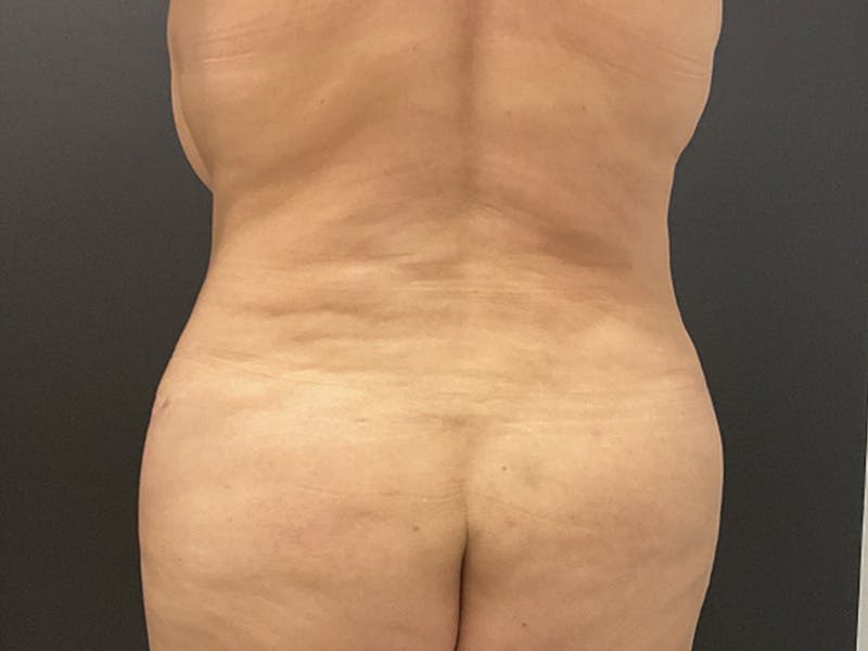 Tummy Tuck Before & After Gallery - Patient 462190 - Image 4