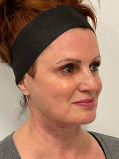 Facelift Before & After Gallery - Patient 329983 - Image 2