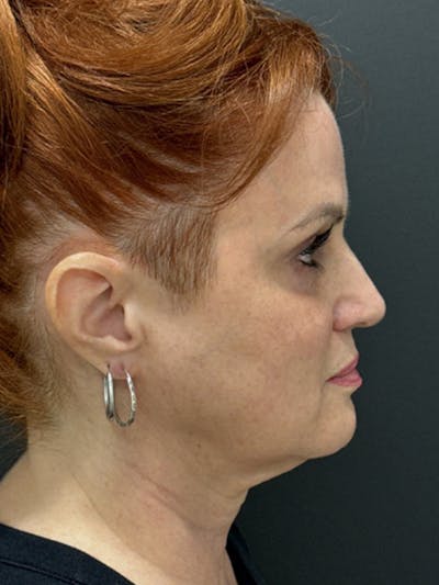 Renuvion Before & After Gallery - Patient 397866 - Image 1