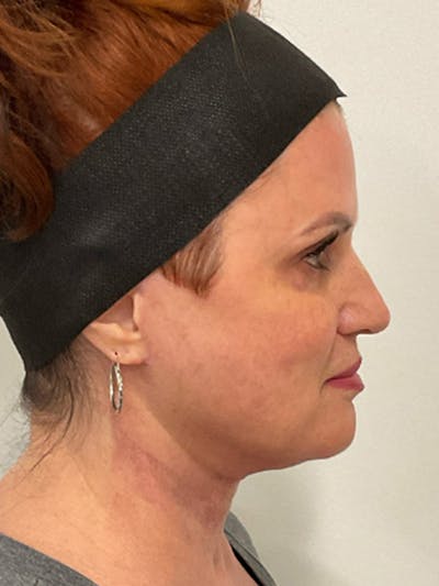 Renuvion Before & After Gallery - Patient 397866 - Image 2