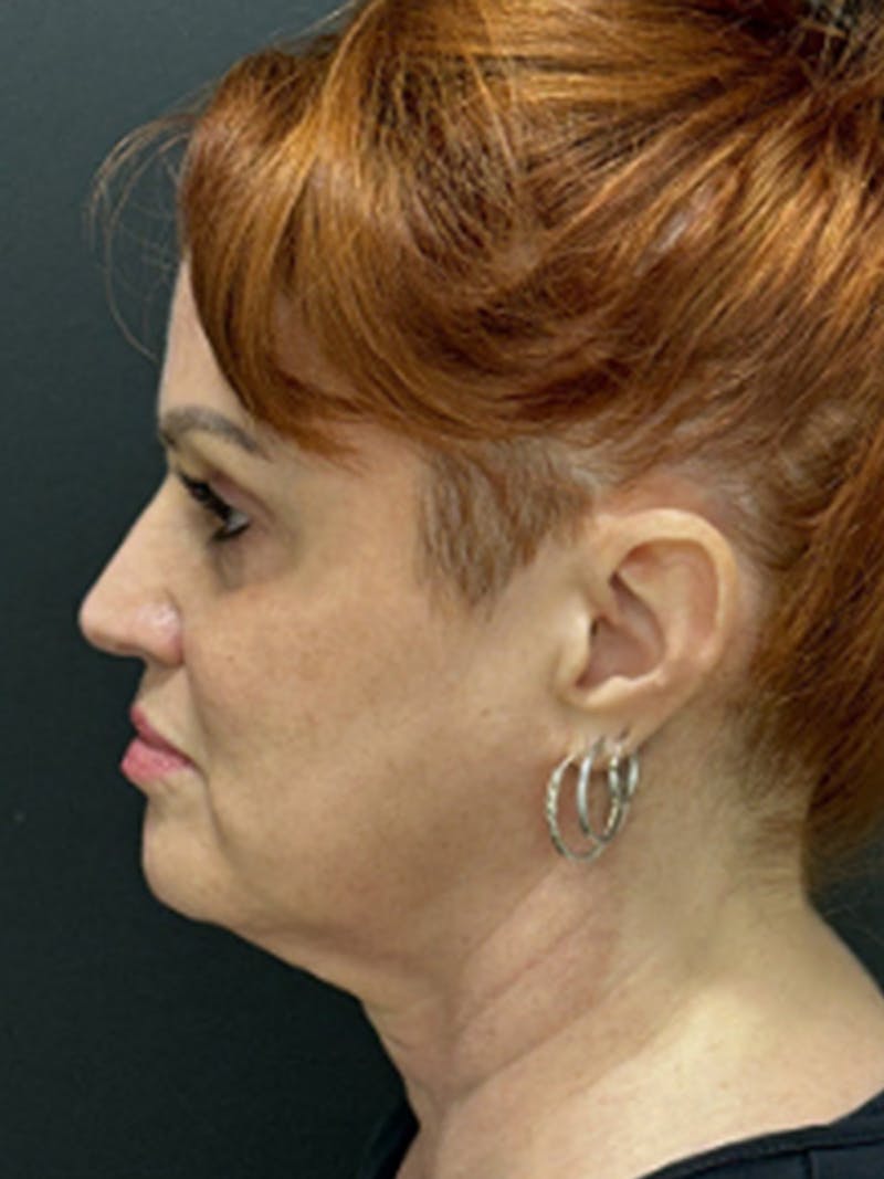 Facelift Before & After Gallery - Patient 329983 - Image 5
