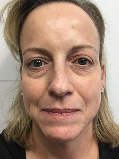 Facial Fat Grafting Before & After Gallery - Patient 615278 - Image 2