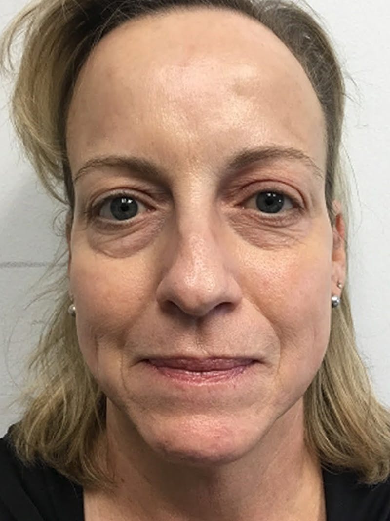 Facial Fat Grafting Before & After Gallery - Patient 615278 - Image 2