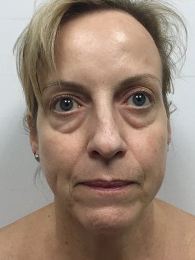Facial Fat Grafting Before & After Gallery - Patient 615278 - Image 1