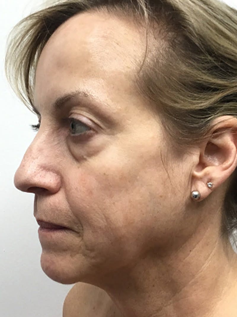 Facial Fat Grafting Before & After Gallery - Patient 615278 - Image 3