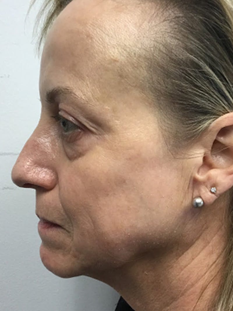 Facial Fat Grafting Before & After Gallery - Patient 615278 - Image 4