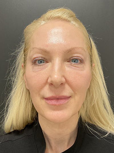Facial Fat Grafting Before & After Gallery - Patient 257508 - Image 1