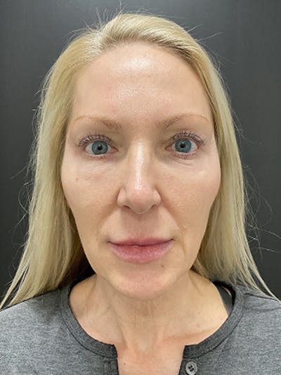 Facial Fat Grafting Before & After Gallery - Patient 257508 - Image 2