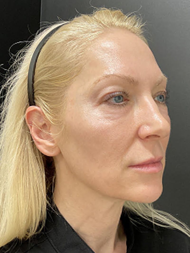 Blepharoplasty Before & After Gallery - Patient 917375 - Image 3