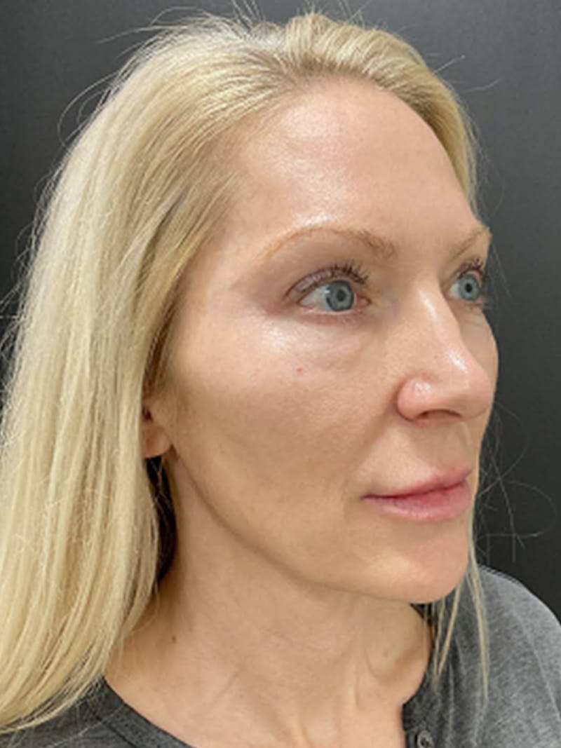 Blepharoplasty Before & After Gallery - Patient 917375 - Image 4