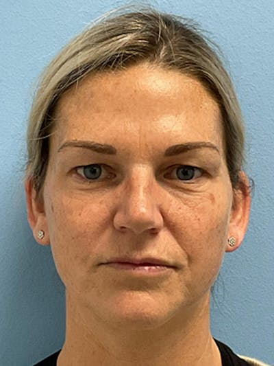 Blepharoplasty Before & After Gallery - Patient 115353 - Image 1