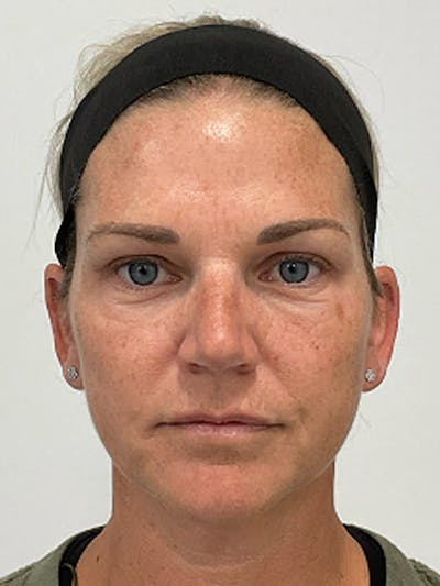 Blepharoplasty Before & After Gallery - Patient 115353 - Image 2