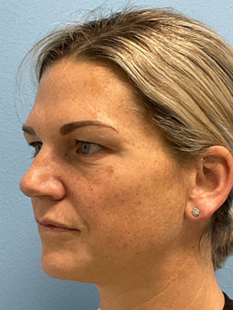 Blepharoplasty Before & After Gallery - Patient 115353 - Image 3