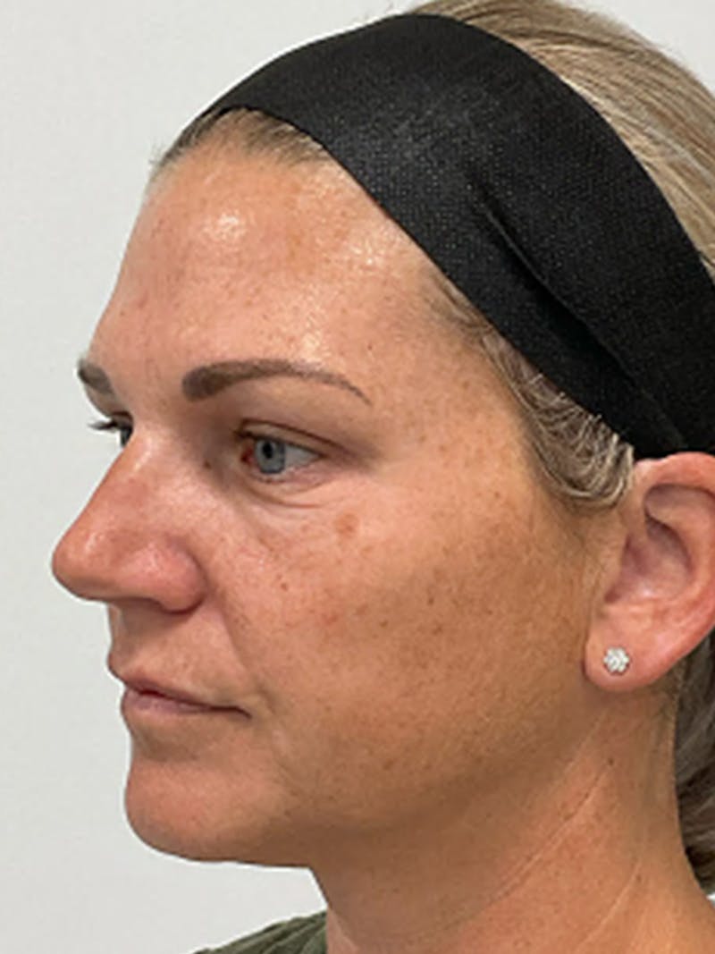 Blepharoplasty Before & After Gallery - Patient 115353 - Image 4