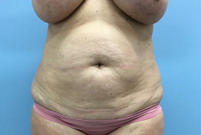 Mommy Makeover Before & After Gallery - Patient 172770 - Image 1