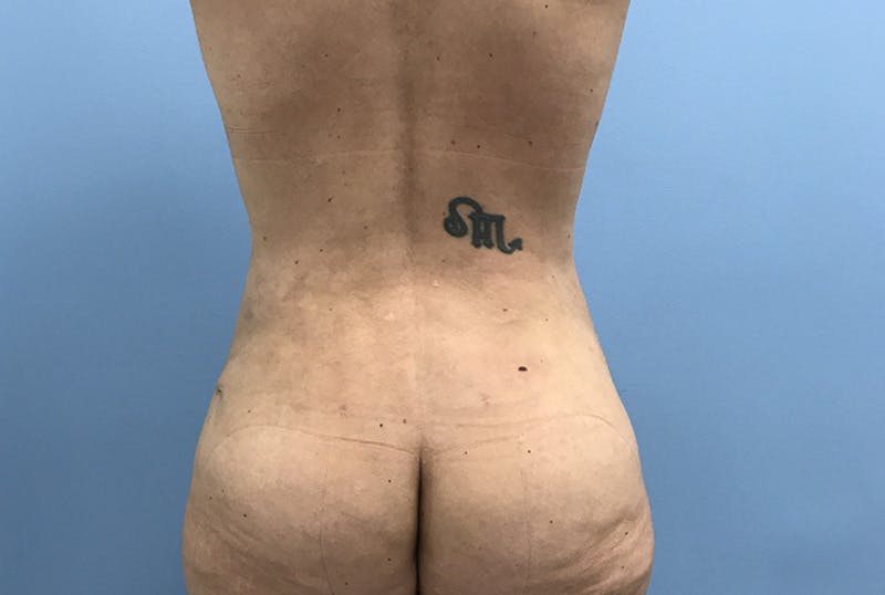 Mommy Makeover Before & After Gallery - Patient 172770 - Image 4