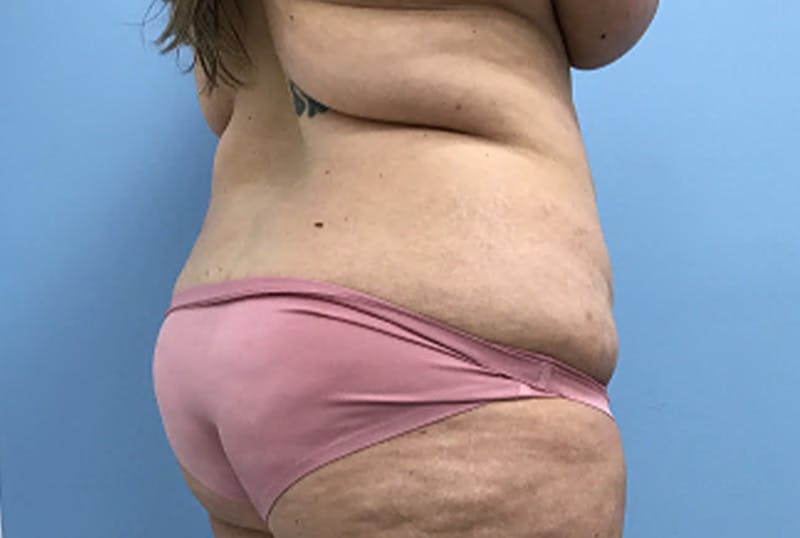 Mommy Makeover Before & After Gallery - Patient 172770 - Image 5
