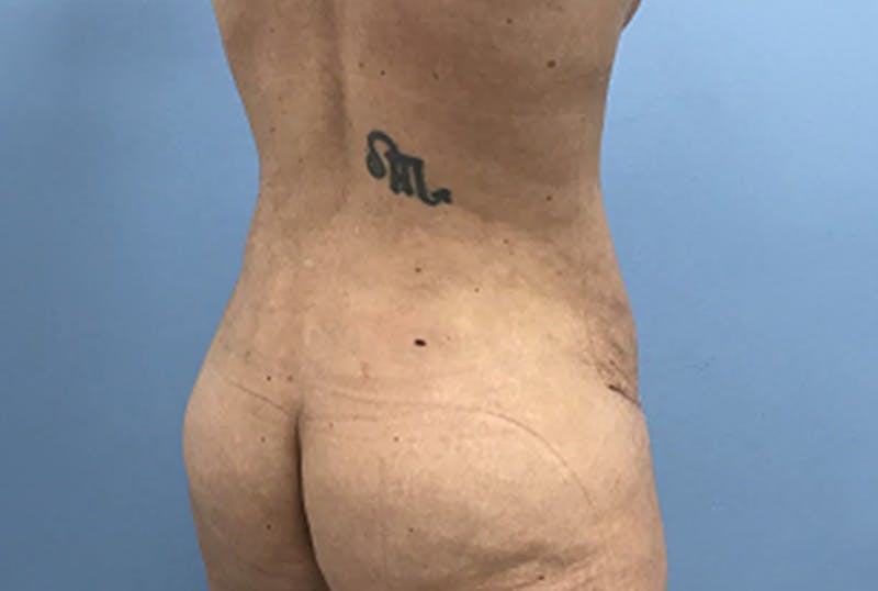 Mommy Makeover Before & After Gallery - Patient 172770 - Image 6