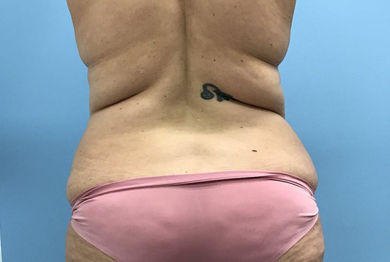 Mommy Makeover Before & After Gallery - Patient 172770 - Image 3