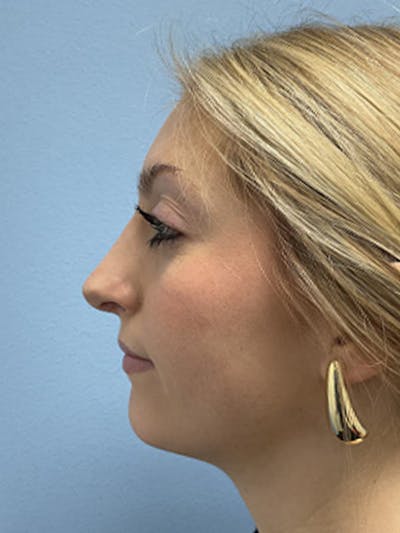 Rhinoplasty Before & After Gallery - Patient 357605 - Image 2