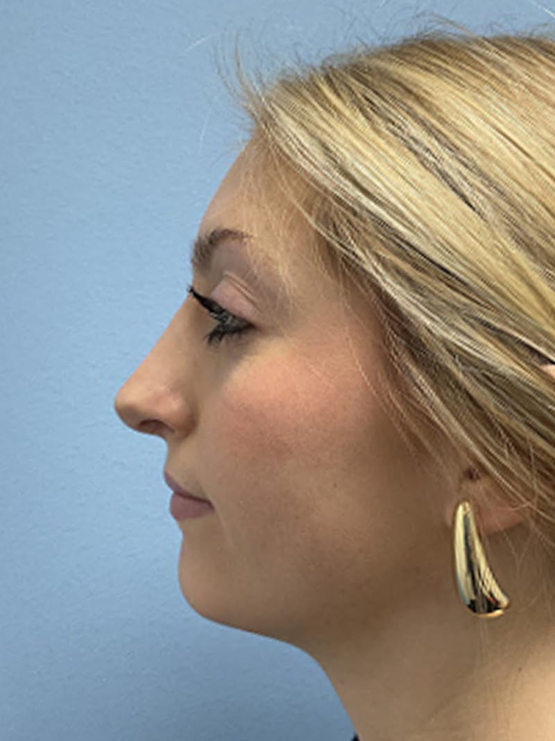 Rhinoplasty Before & After Gallery - Patient 357605 - Image 2