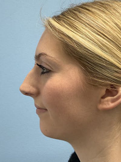 Rhinoplasty Before & After Gallery - Patient 357605 - Image 1