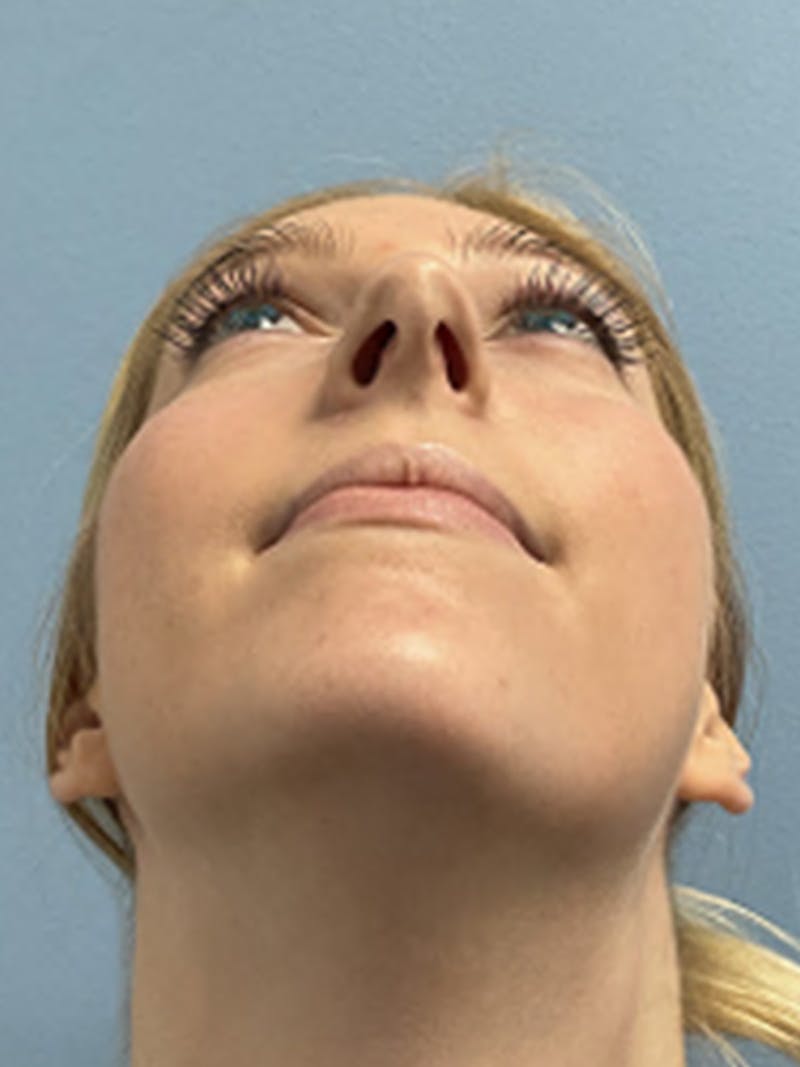 Rhinoplasty Before & After Gallery - Patient 357605 - Image 3