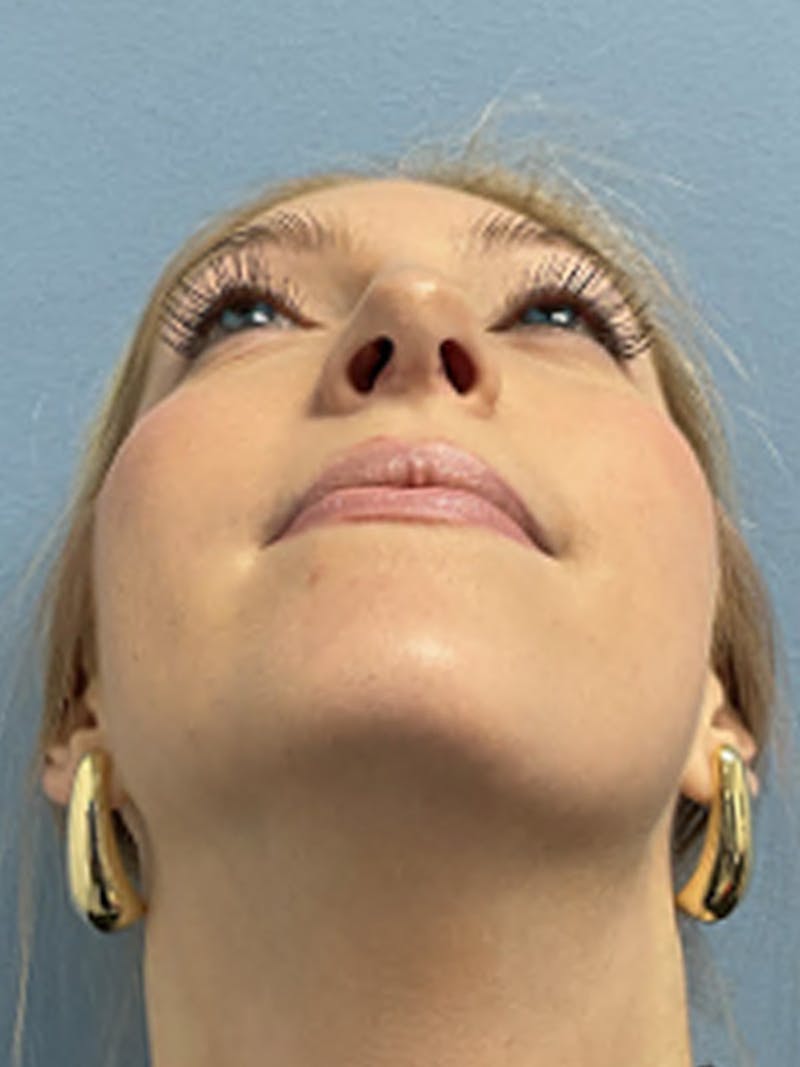 Rhinoplasty Before & After Gallery - Patient 357605 - Image 4