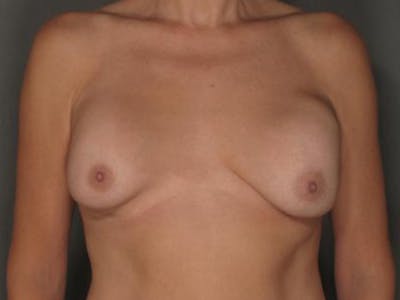 Breast Revision Before & After Gallery - Patient 120903132 - Image 1