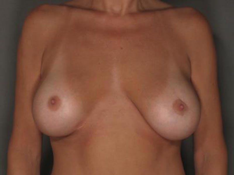 Breast Revision Before & After Gallery - Patient 120903132 - Image 2