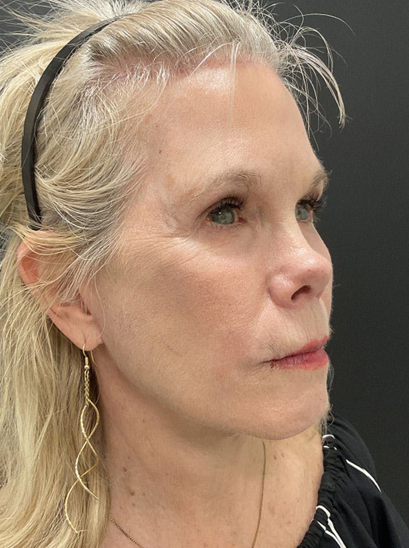 Facelift Before & After Gallery - Patient 386731 - Image 8