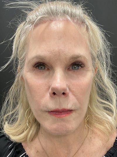 Facelift Before & After Gallery - Patient 386731 - Image 2