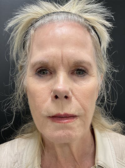 Facelift Before & After Gallery - Patient 386731 - Image 1