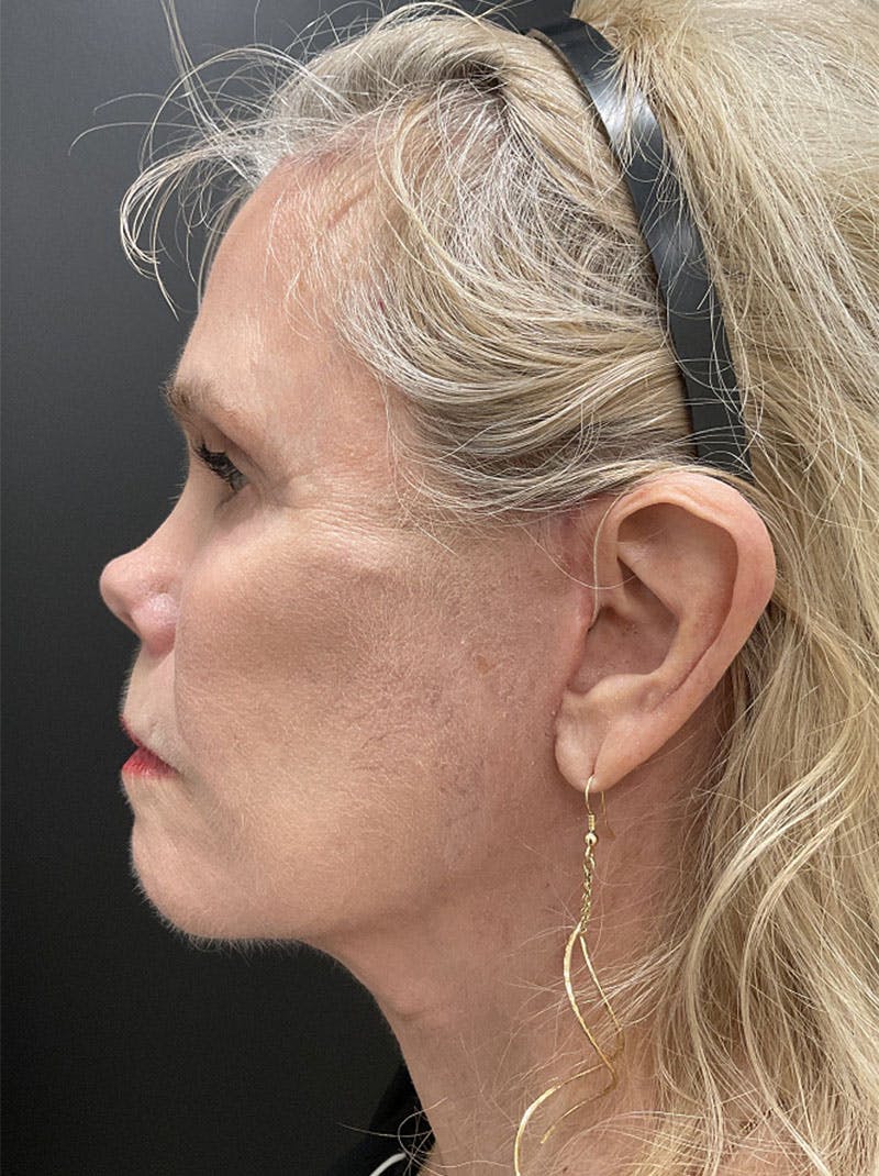 Facelift Before & After Gallery - Patient 386731 - Image 6