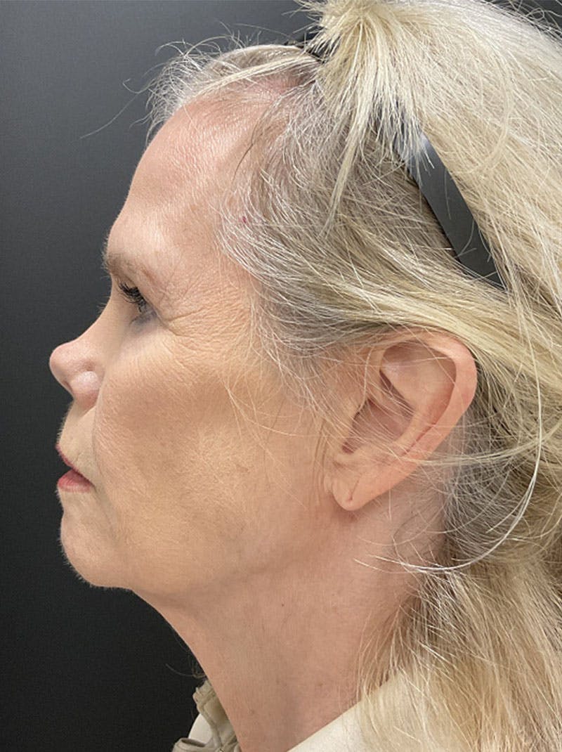 Facelift Before & After Gallery - Patient 386731 - Image 5