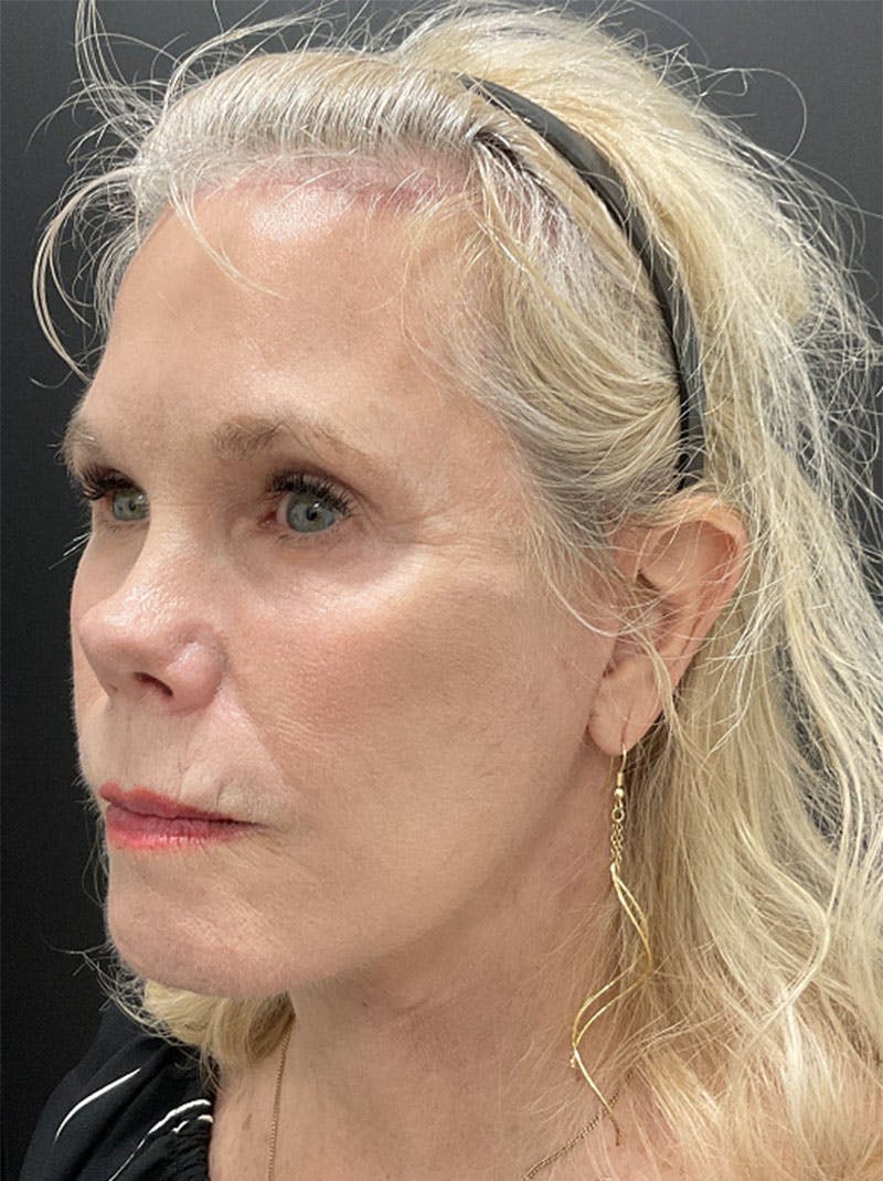 Facelift Before & After Gallery - Patient 386731 - Image 4