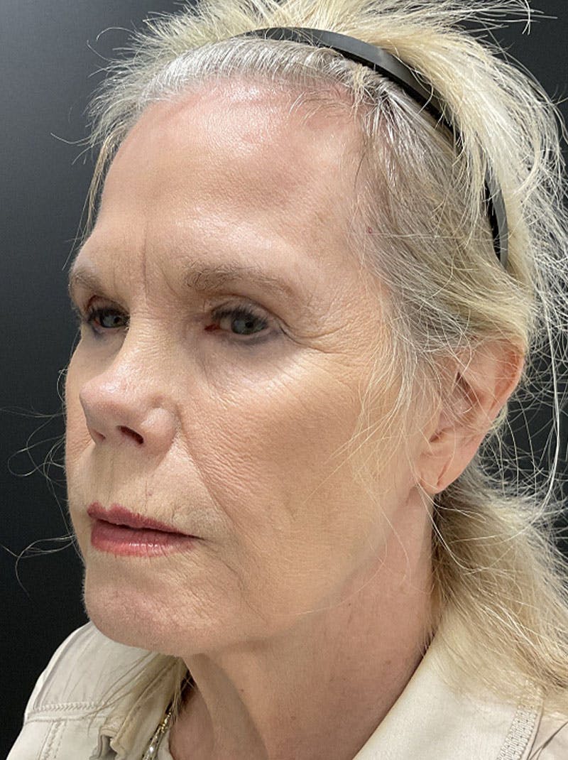 Facelift Before & After Gallery - Patient 386731 - Image 3