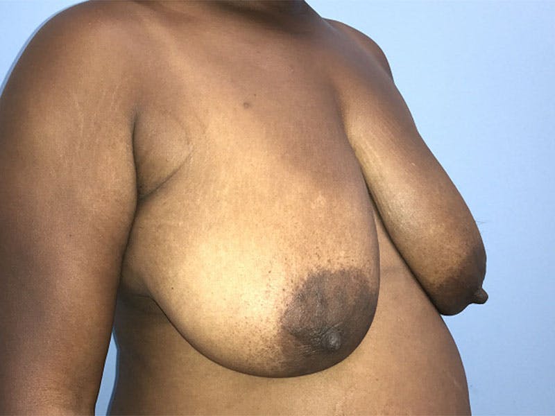 Breast Reduction Before & After Gallery - Patient 960254 - Image 3