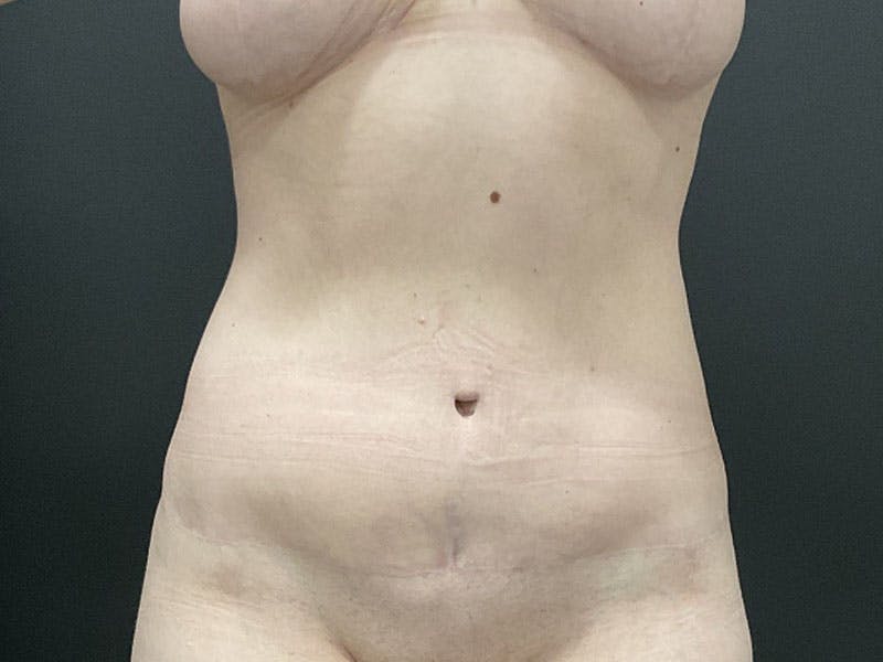 Mommy Makeover Before & After Gallery - Patient 366023 - Image 4