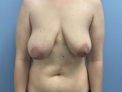 Mommy Makeover Before & After Gallery - Patient 366023 - Image 1