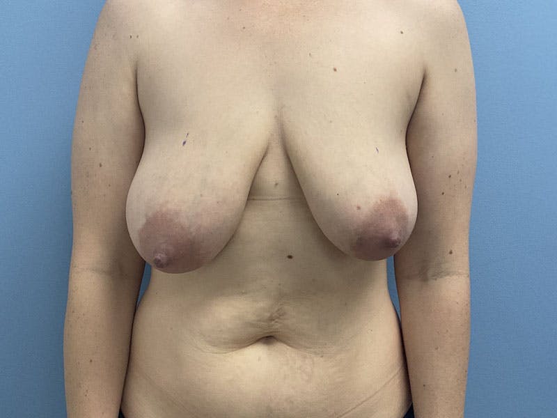 Mommy Makeover Before & After Gallery - Patient 366023 - Image 1