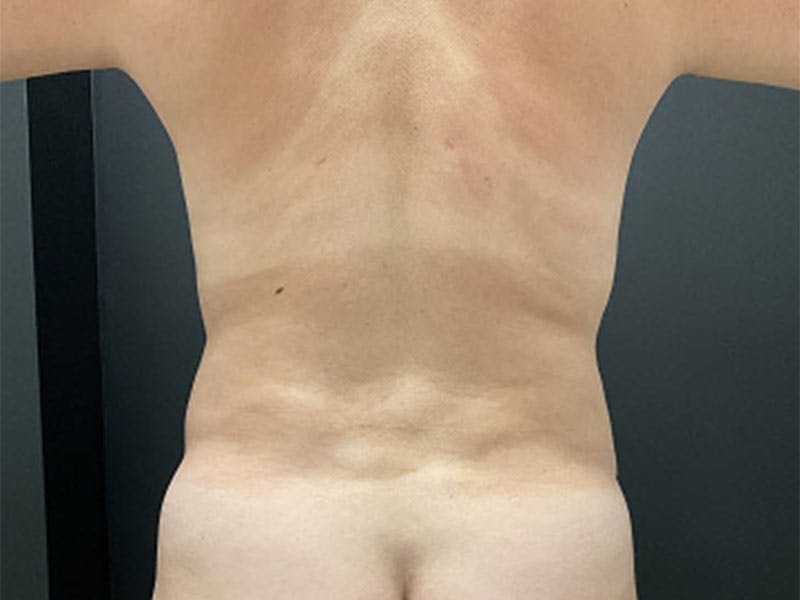 Mommy Makeover Before & After Gallery - Patient 275943 - Image 6