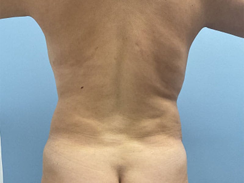 Mommy Makeover Before & After Gallery - Patient 275943 - Image 5