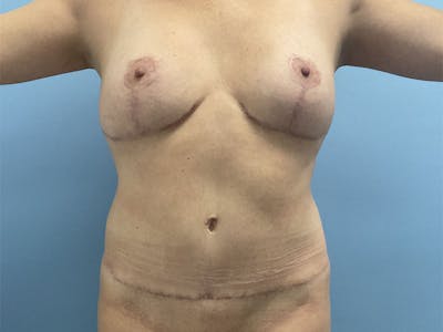 Mommy Makeover Before & After Gallery - Patient 275943 - Image 2