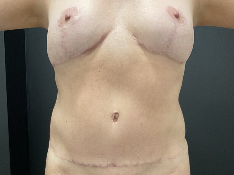 Mommy Makeover Before & After Gallery - Patient 275943 - Image 8