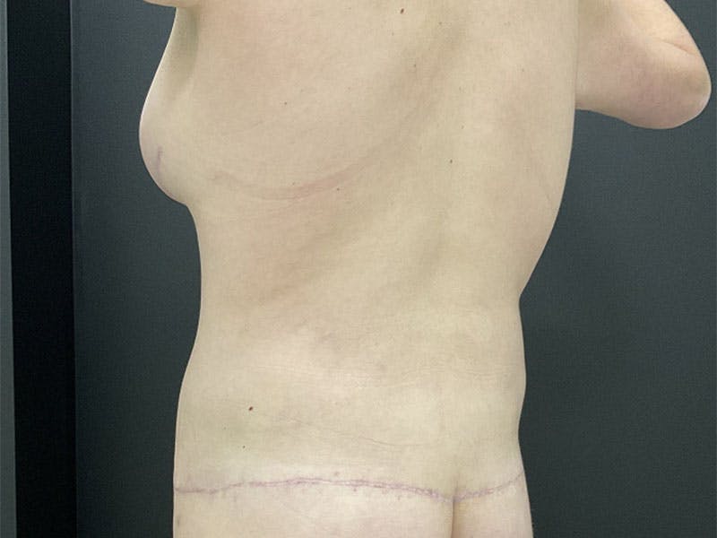 Mommy Makeover Before & After Gallery - Patient 393328 - Image 6