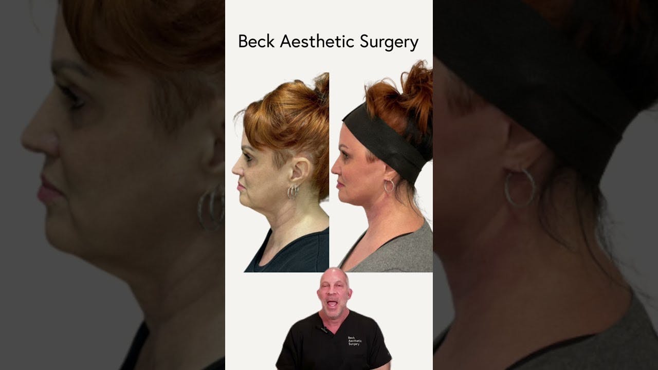 Before and After Facelift thumbnail